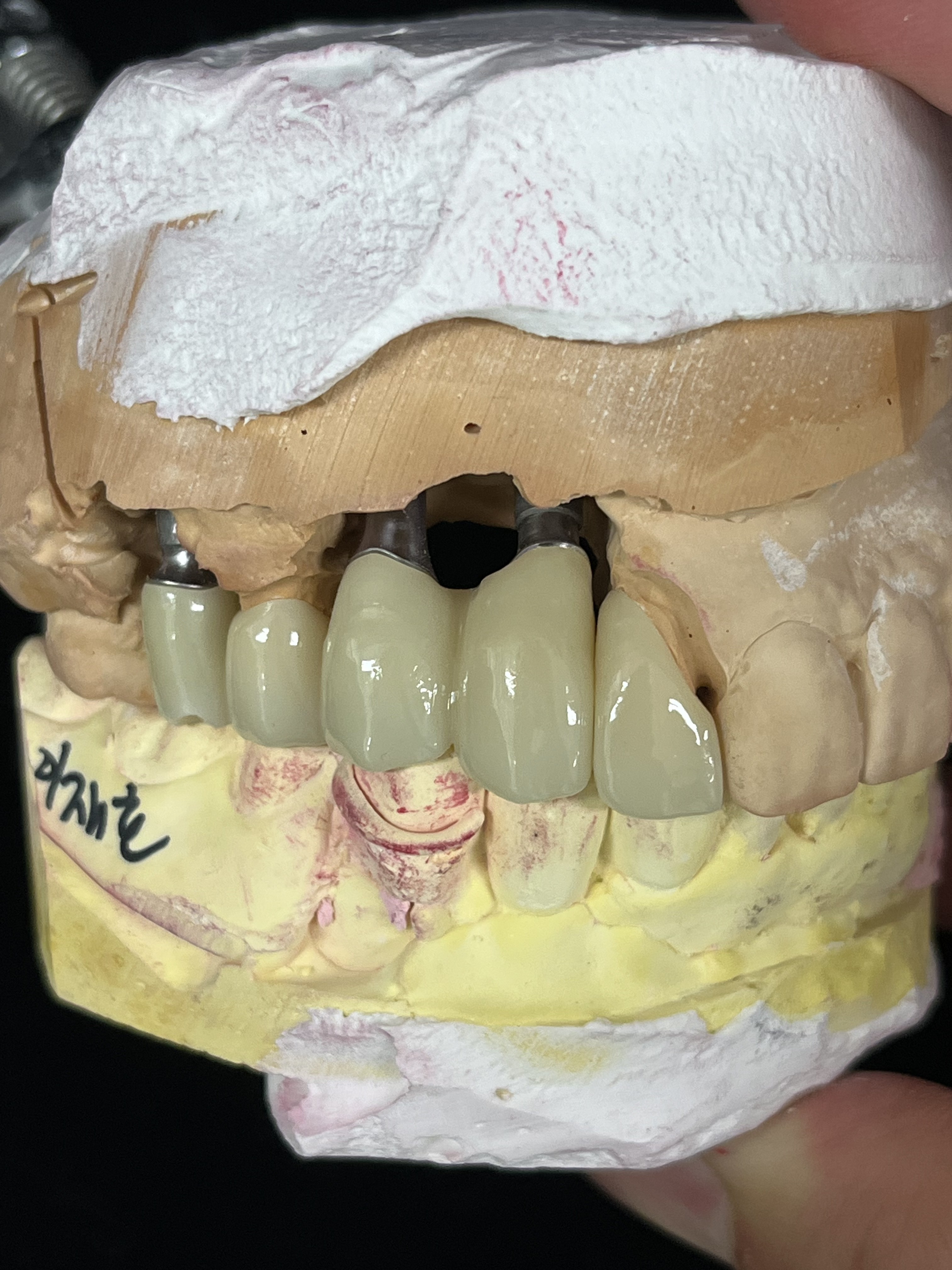 임플란트 전치부 브릿지